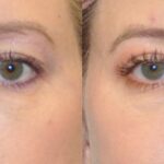 Upper Eyelid Lift (Blepharoplasty) #5 - Before and After
