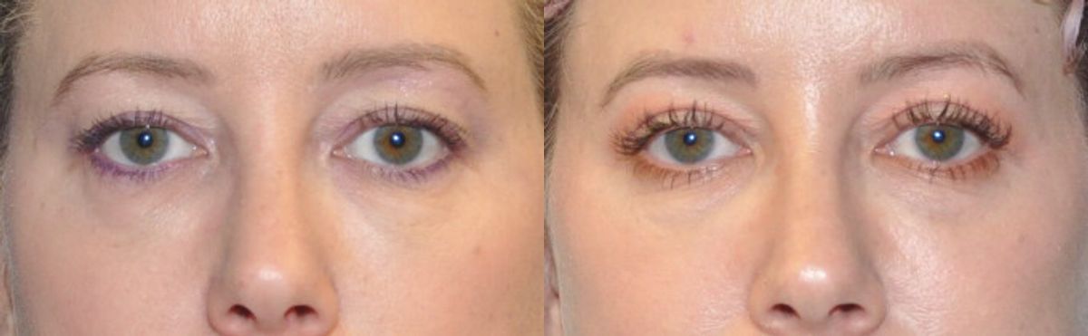 Upper Eyelid Lift (Blepharoplasty) #5 - Before and After