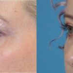 Upper Eyelid Lift (Blepharoplasty) #5 - Before and After