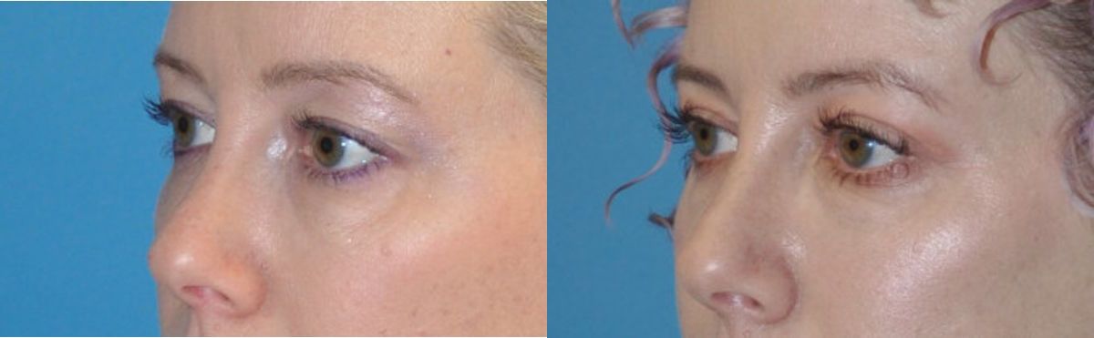 Upper Eyelid Lift (Blepharoplasty) #5 - Before and After