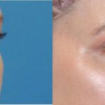 Upper Eyelid Lift (Blepharoplasty) #5 - Before and After
