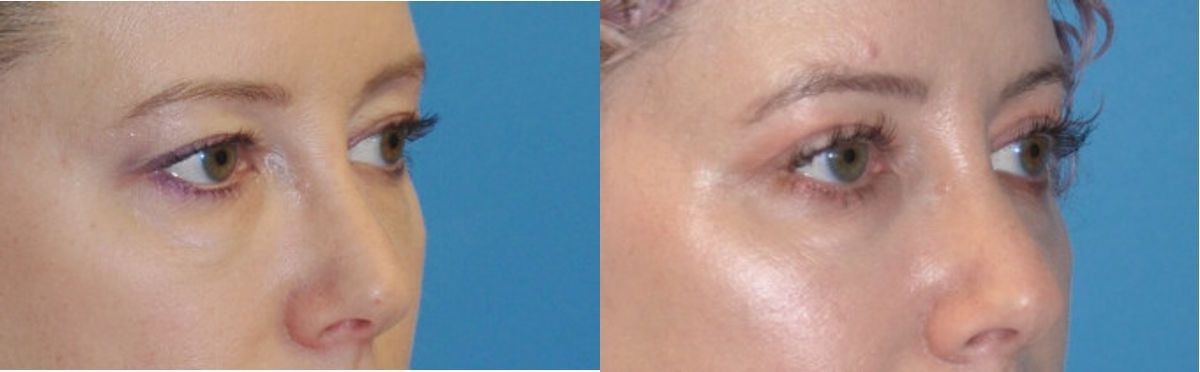 Upper Eyelid Lift (Blepharoplasty) #5 - Before and After
