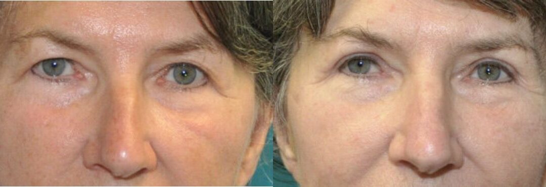 Upper Blepharoplasty (Eyelid Lift) #6