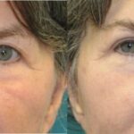 Upper Blepharoplasty (Eyelid Lift) #6 - Before and After