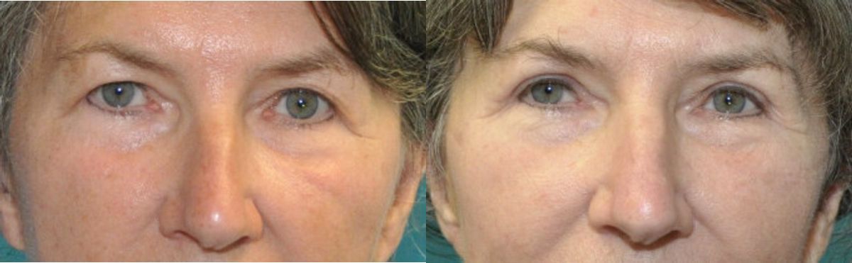 Upper Blepharoplasty (Eyelid Lift) #6 - Before and After