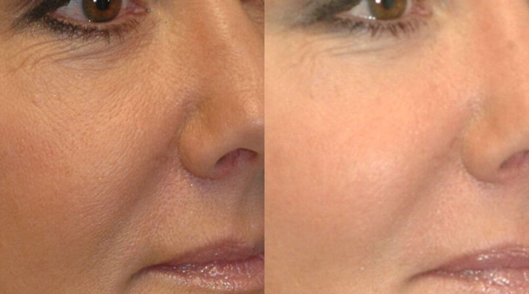 Voluma for midface