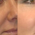 Voluma for midface - Before and After