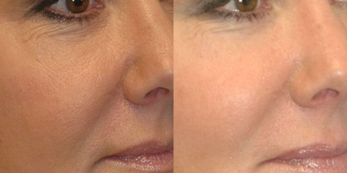 Voluma for midface - Before and After