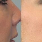 Voluma for midface - Before and After