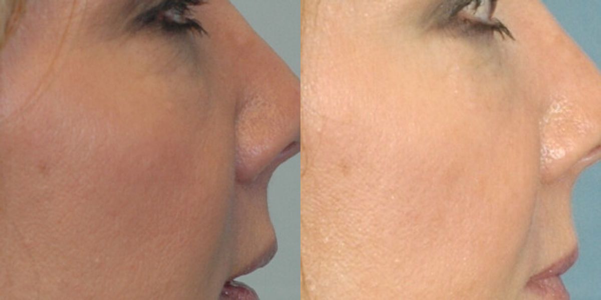 Voluma for midface - Before and After