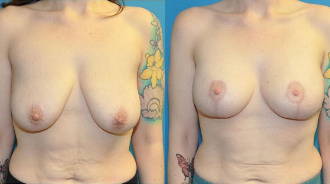 Breast Augmentation & Lift #2