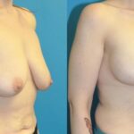 Breast Augmentation & Lift #2 - Before and After