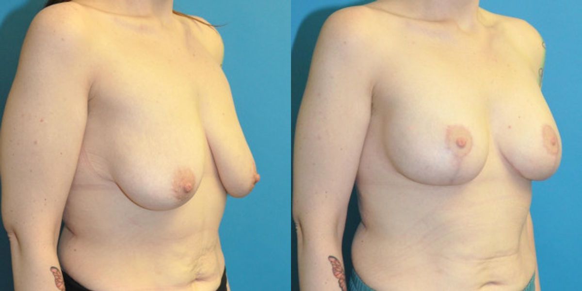 Breast Augmentation & Lift #2 - Before and After