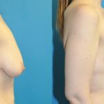 Breast Augmentation & Lift #2 - Before and After