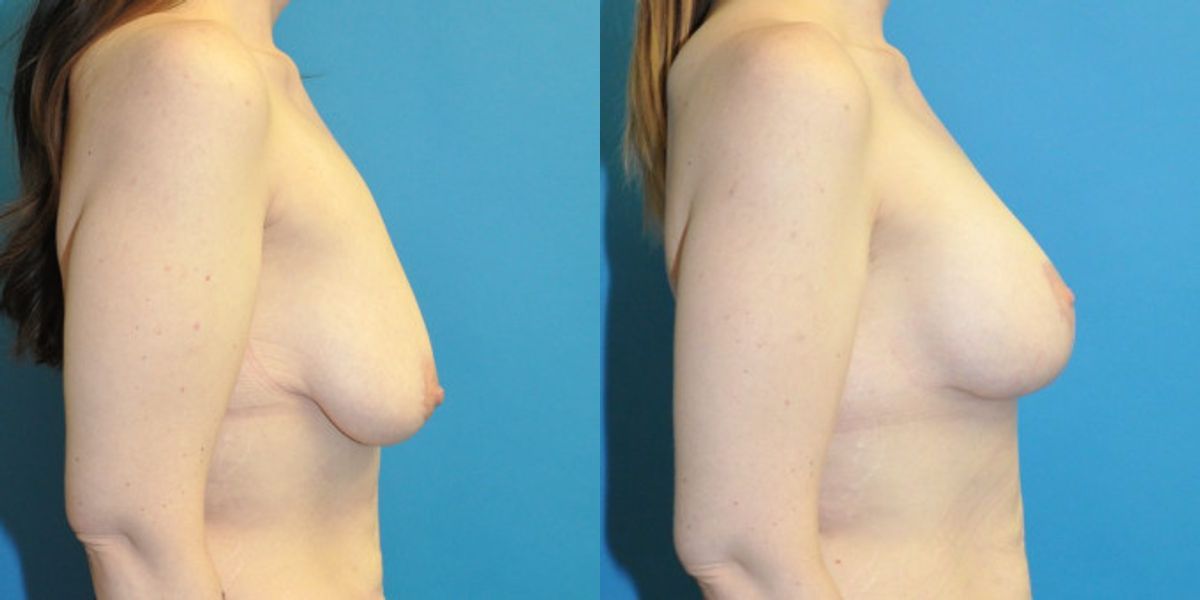 Breast Augmentation & Lift #2 - Before and After
