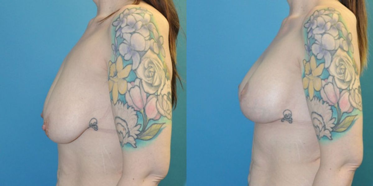 Breast Augmentation & Lift #2 - Before and After