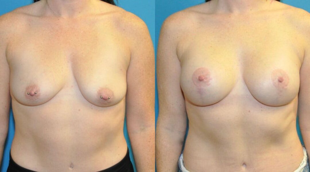 Breast Augmentation & Lift #6
