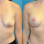 Breast Augmentation & Lift #6 - Before and After