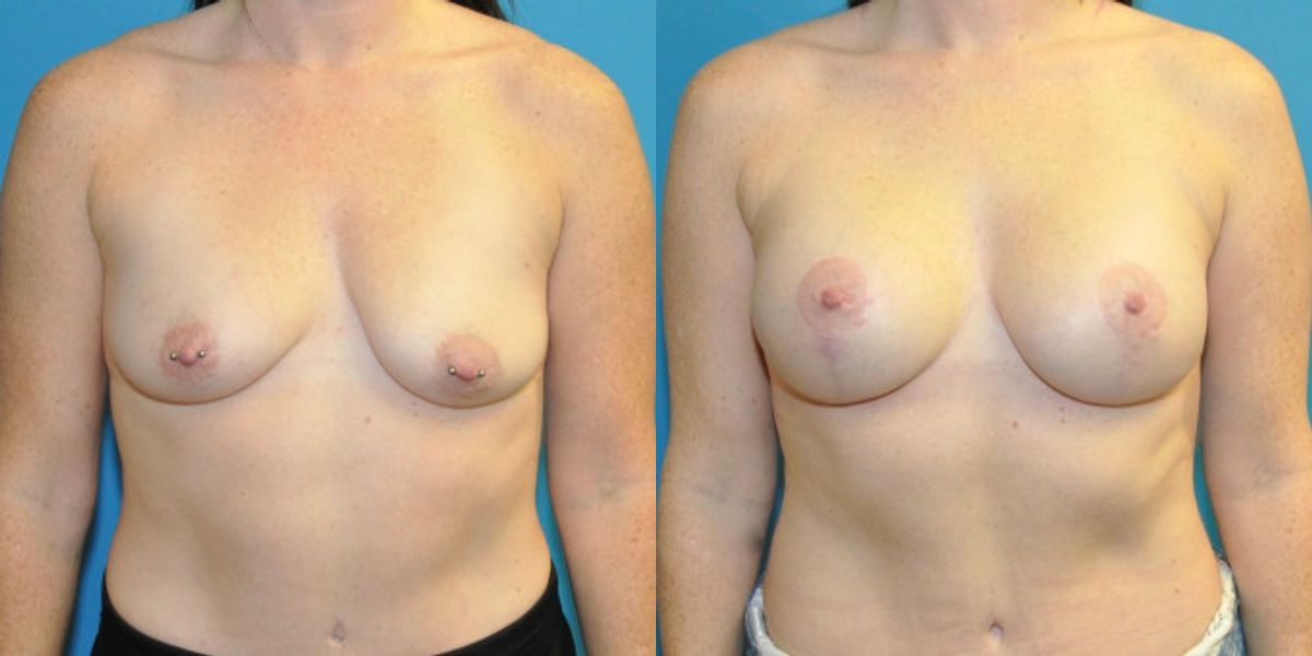 Breast Augmentation & Lift #6 - Before and After
