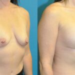 Breast Augmentation & Lift #6 - Before and After