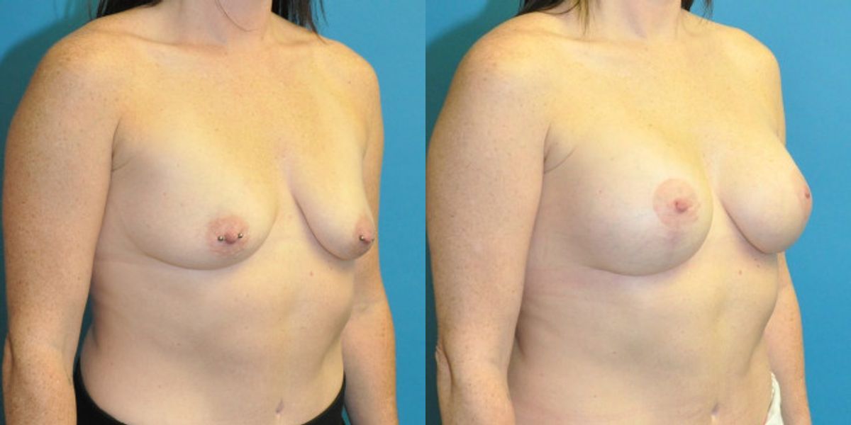 Breast Augmentation & Lift #6 - Before and After