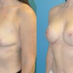 Breast Augmentation & Lift #6 - Before and After