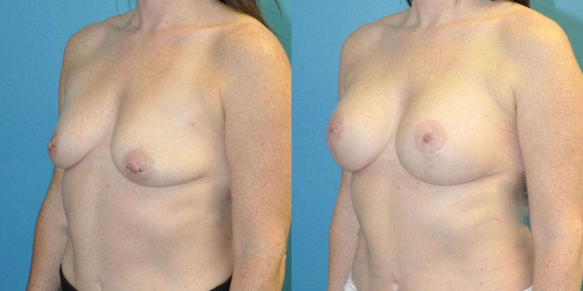 Breast Augmentation & Lift #6 - Before and After