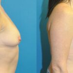 Breast Augmentation & Lift #6 - Before and After