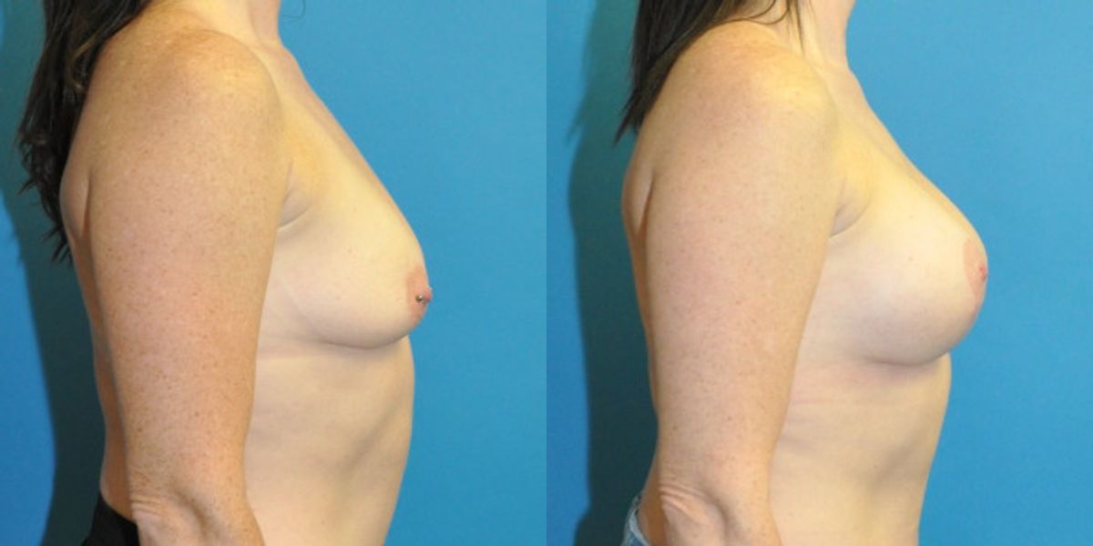 Breast Augmentation & Lift #6 - Before and After