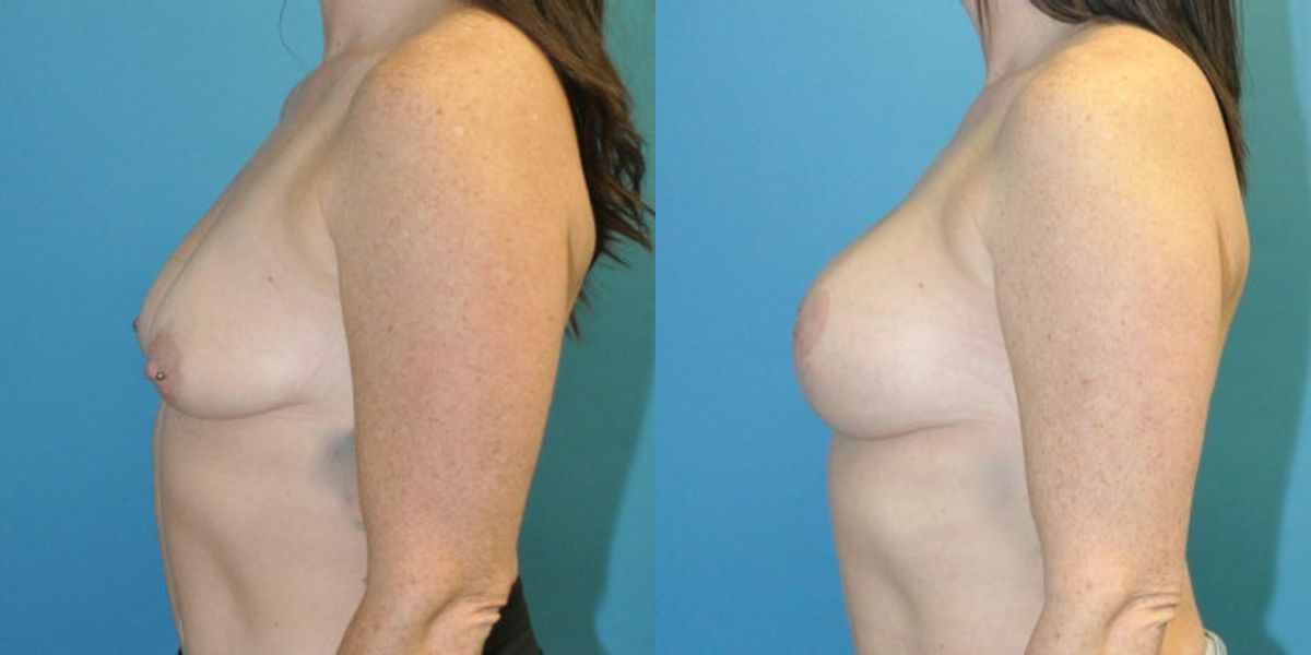 Breast Augmentation & Lift #6 - Before and After