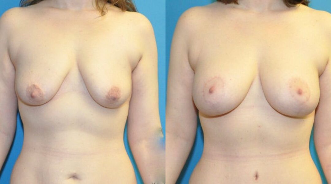 Breast Augmentation & Lift #7