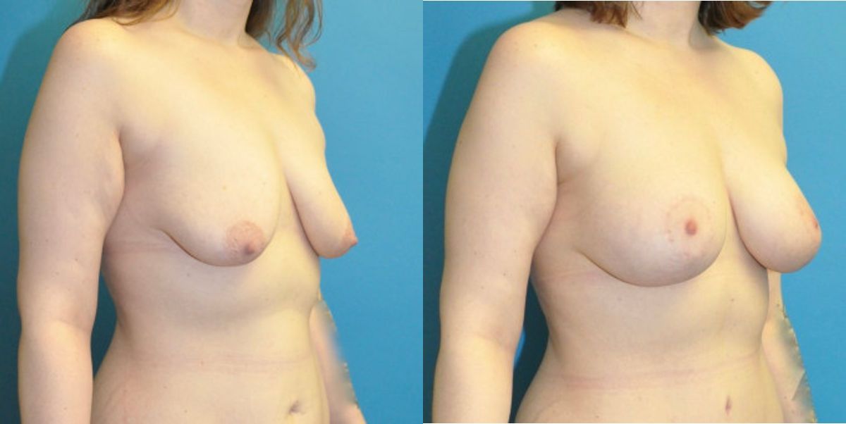Breast Augmentation & Lift #7 - Before and After