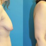 Breast Augmentation & Lift #7 - Before and After