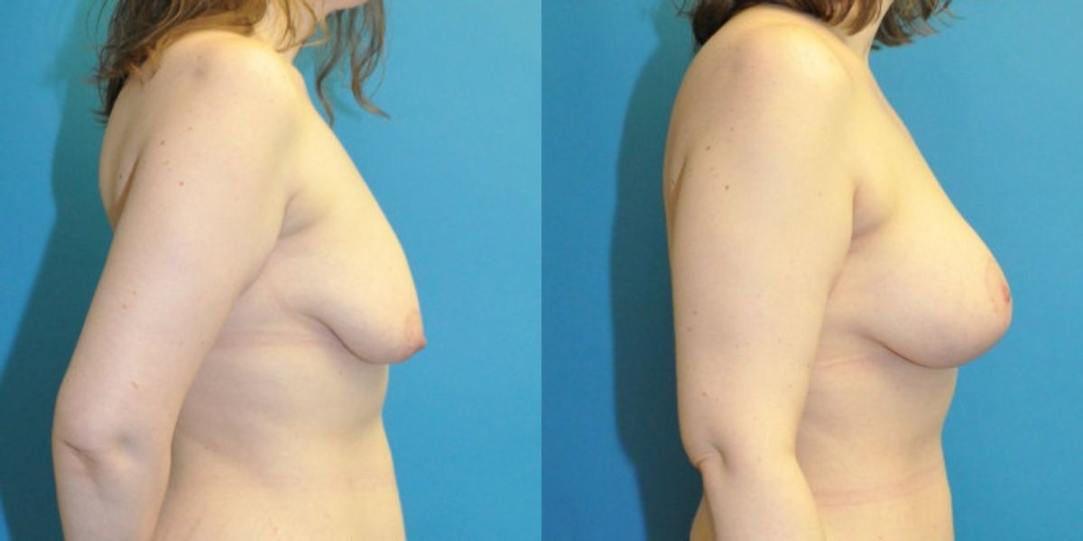 Breast Augmentation & Lift #7 - Before and After