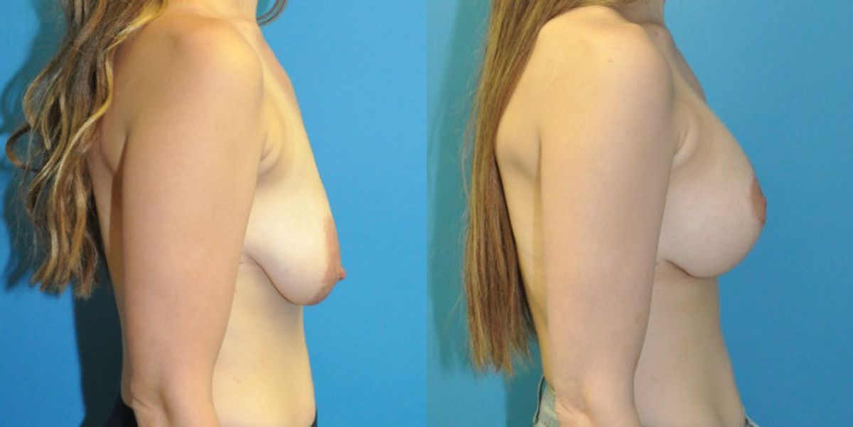 Breast Augmentation & Lift #8 - Before and After