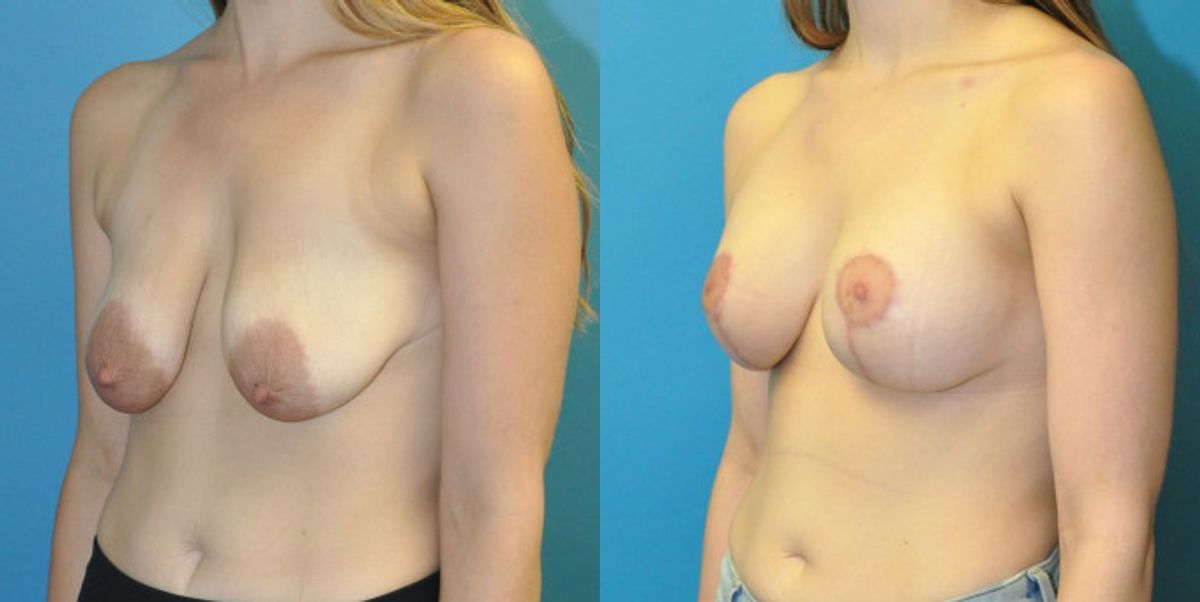 Breast Augmentation & Lift #8 - Before and After