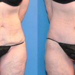 Lower Body Lift #10 - Before and After