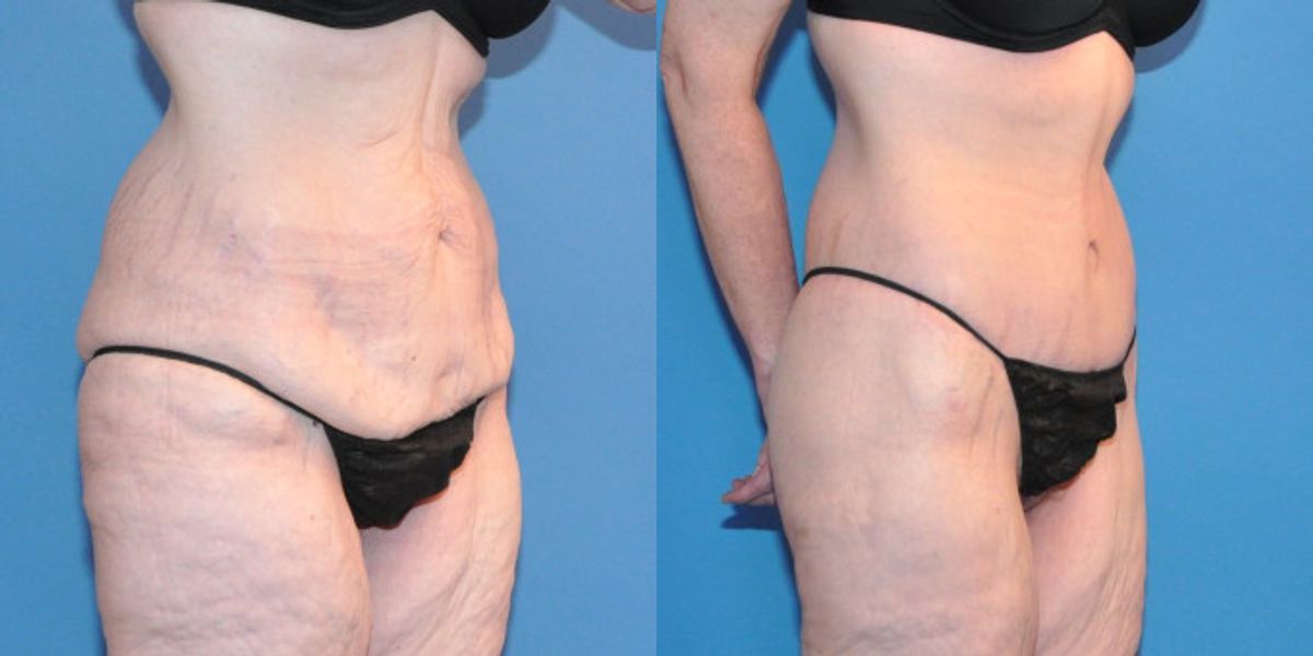 Lower Body Lift #10 - Before and After