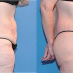 Lower Body Lift #10 - Before and After