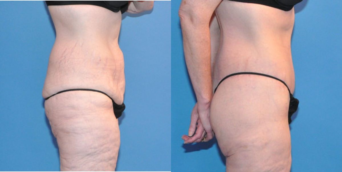 Lower Body Lift #10 - Before and After