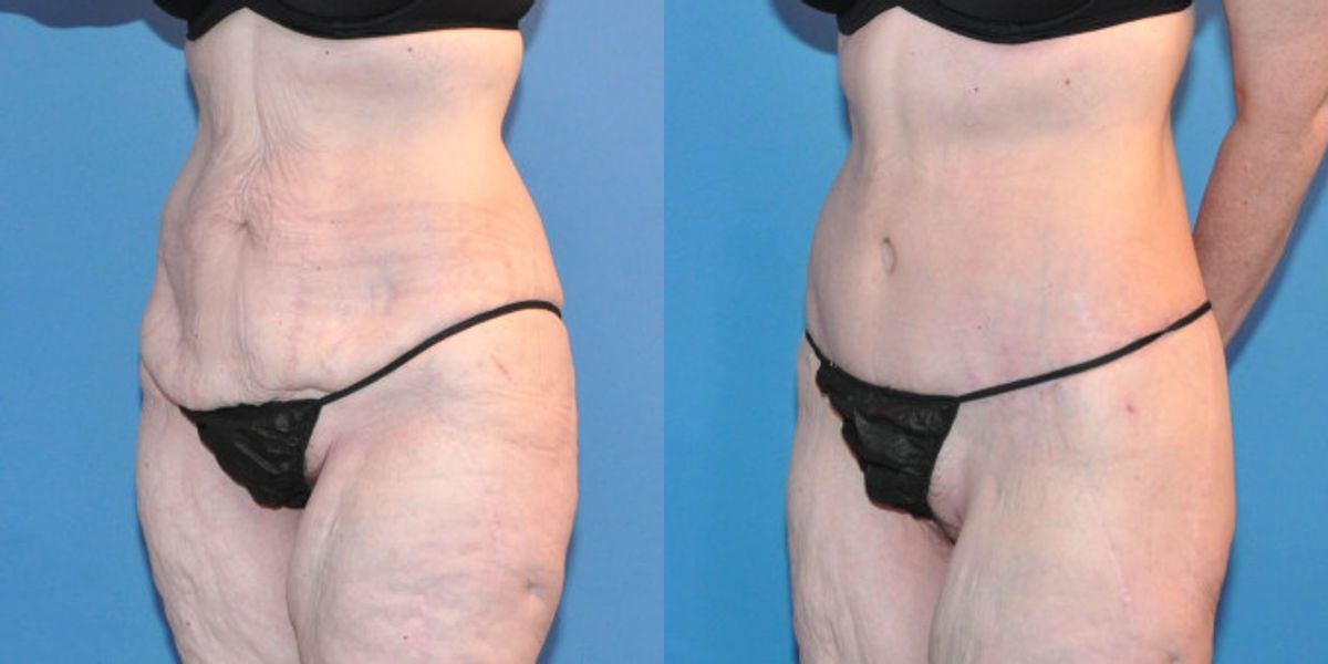 Lower Body Lift #10 - Before and After
