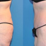 Lower Body Lift #10 - Before and After