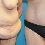 Lower Body Lift #11 - Before and After