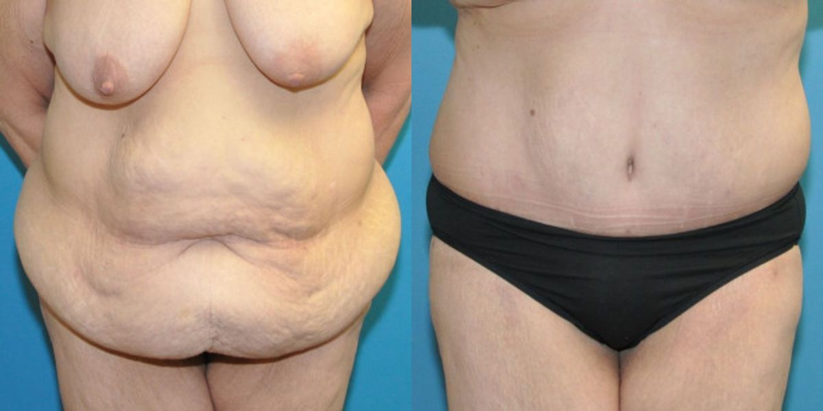 Lower Body Lift #11 - Before and After