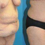 Lower Body Lift #11 - Before and After