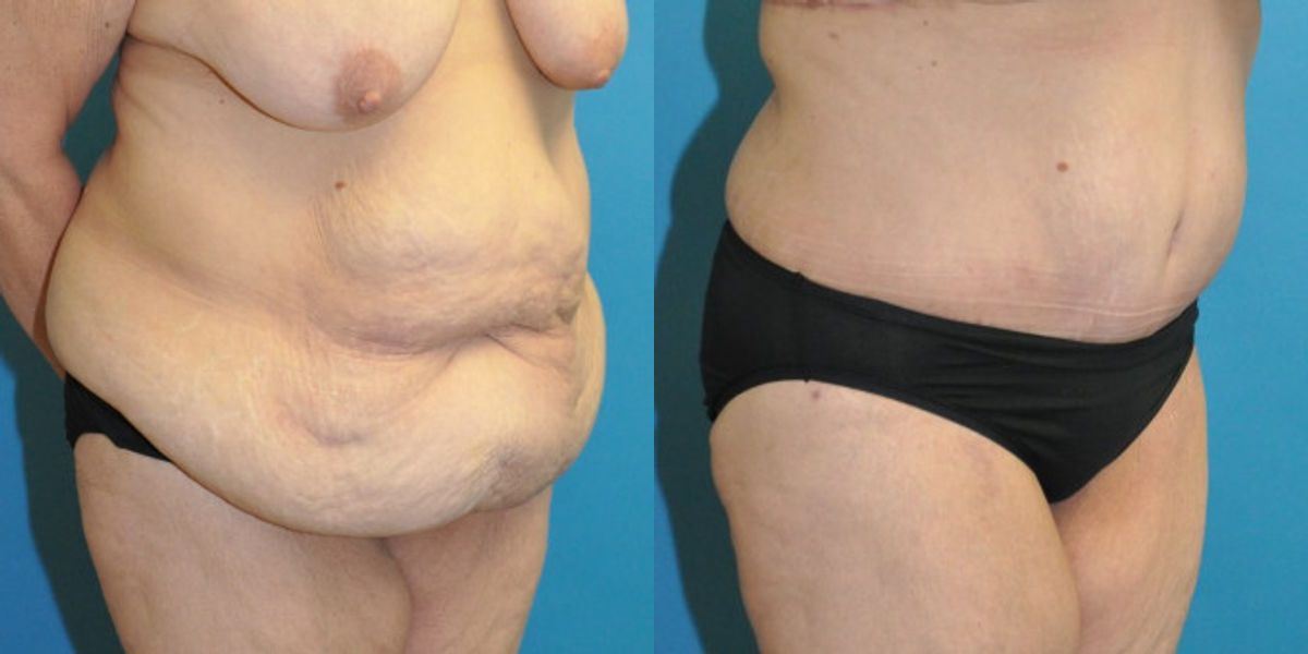 Lower Body Lift #11 - Before and After