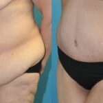 Lower Body Lift #11 - Before and After