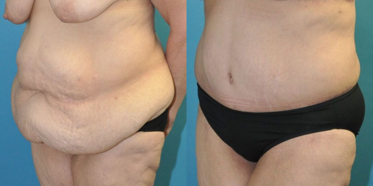 Lower Body Lift #11 - Before and After