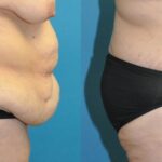 Lower Body Lift #11 - Before and After