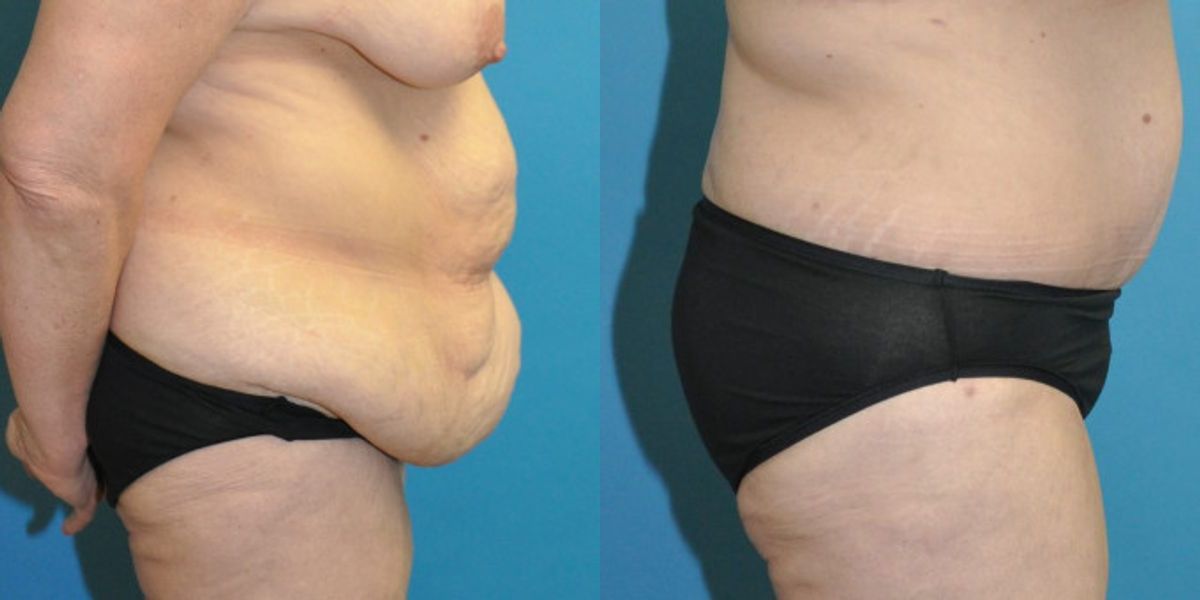 Lower Body Lift #11 - Before and After